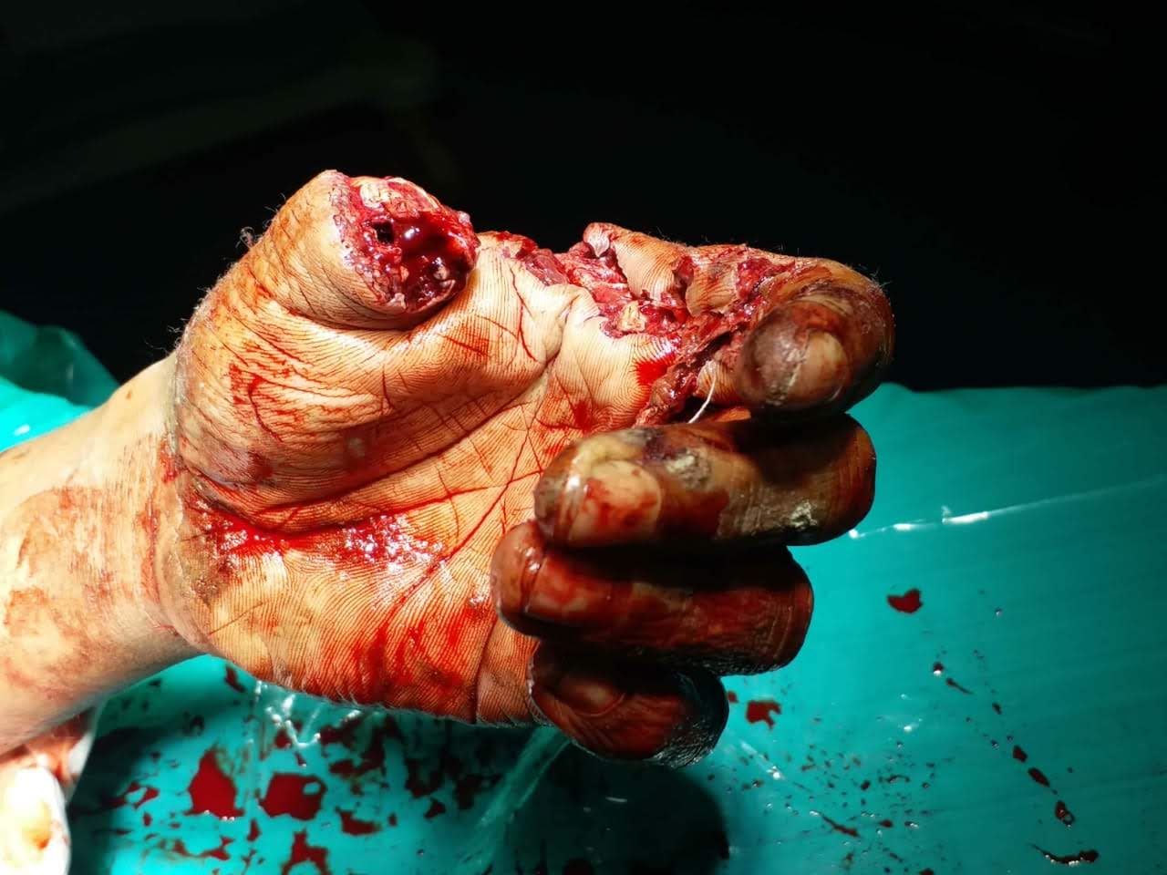 Hand without thumb and other injuries are seen