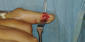 Tumors of hand