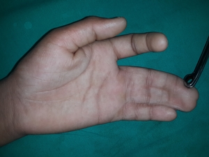 Paediatric Hand Disorders - Dr Nilesh Darawade