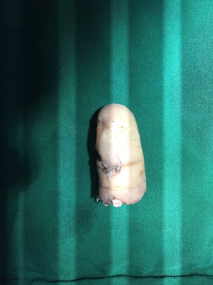 Amputated thumb