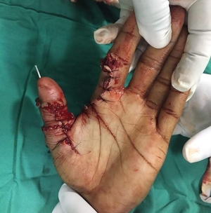 Thumb reattached to hand